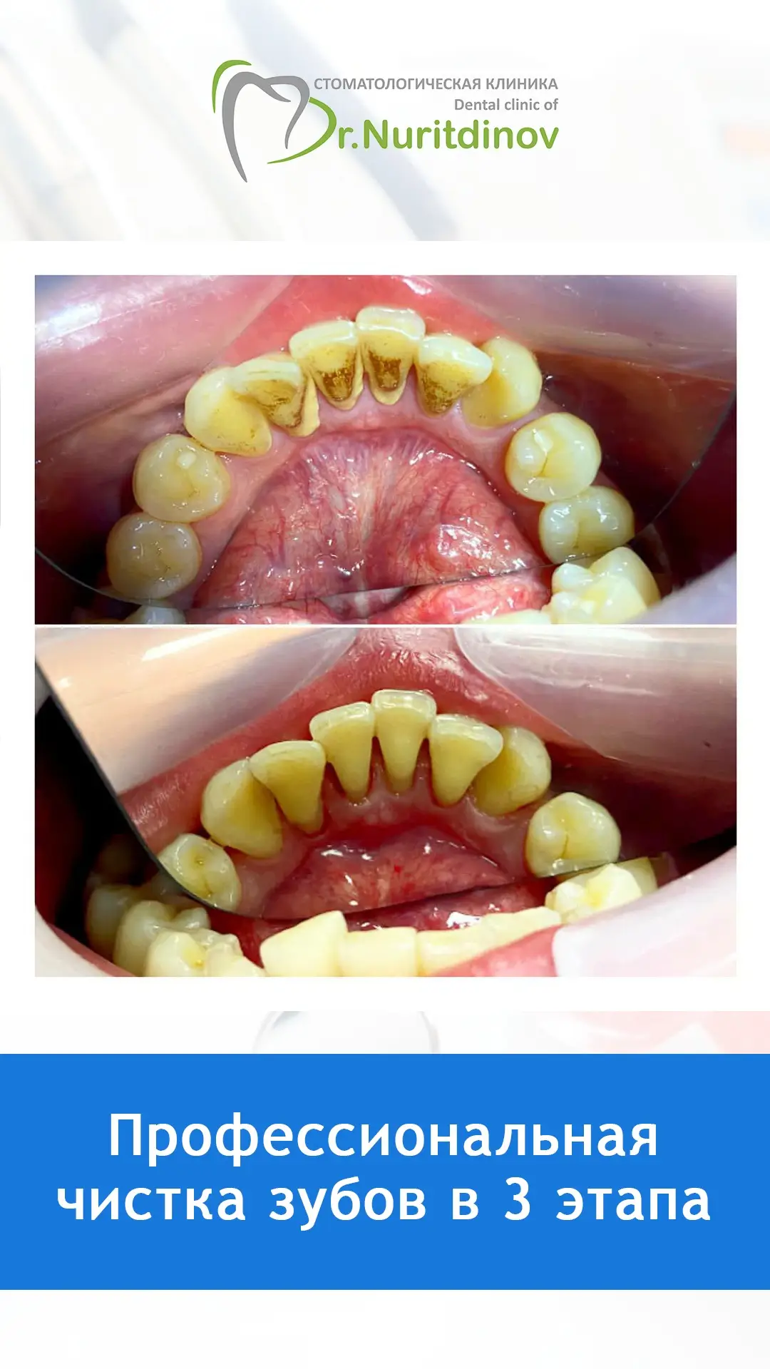 Профессиональная чистка