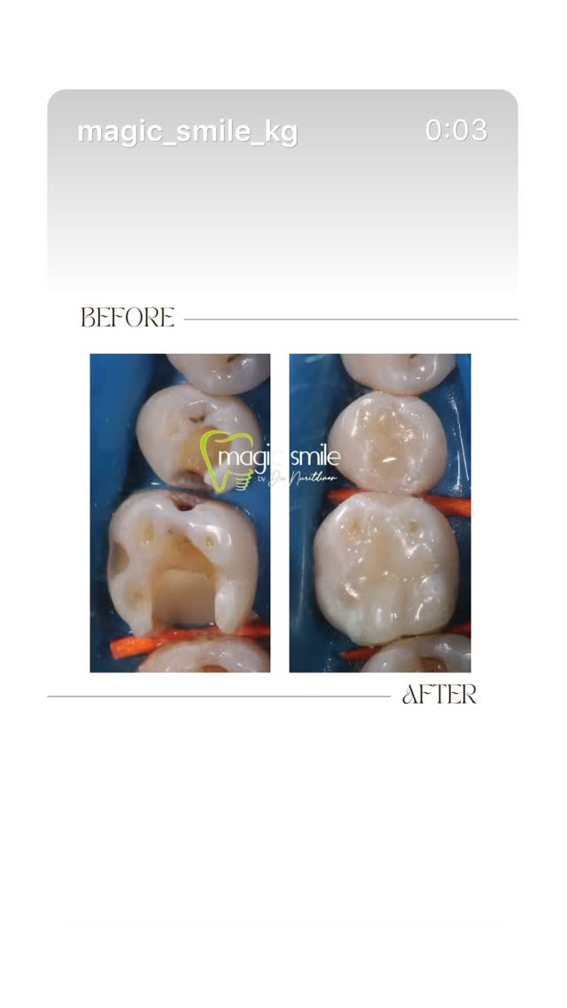 Голливудская улыбка