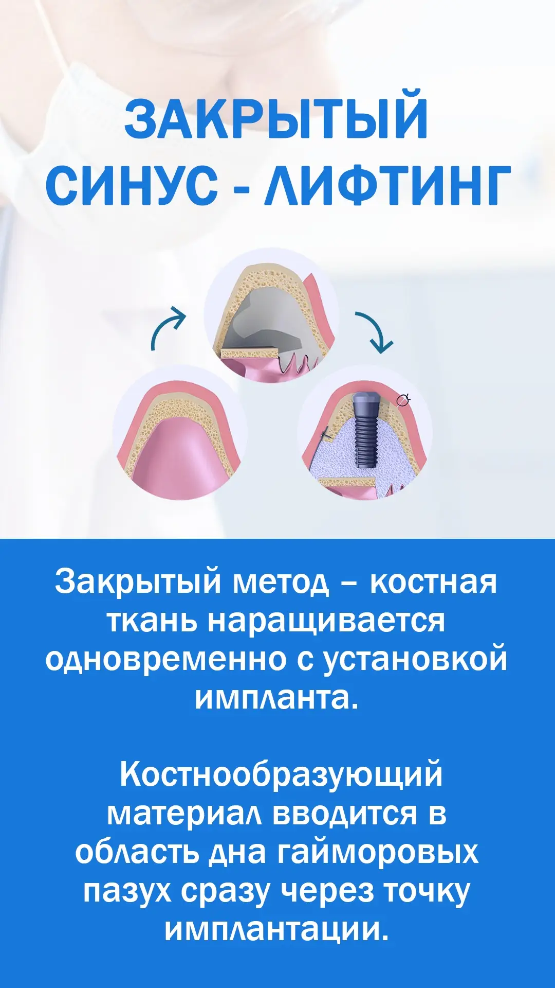 Имплантация