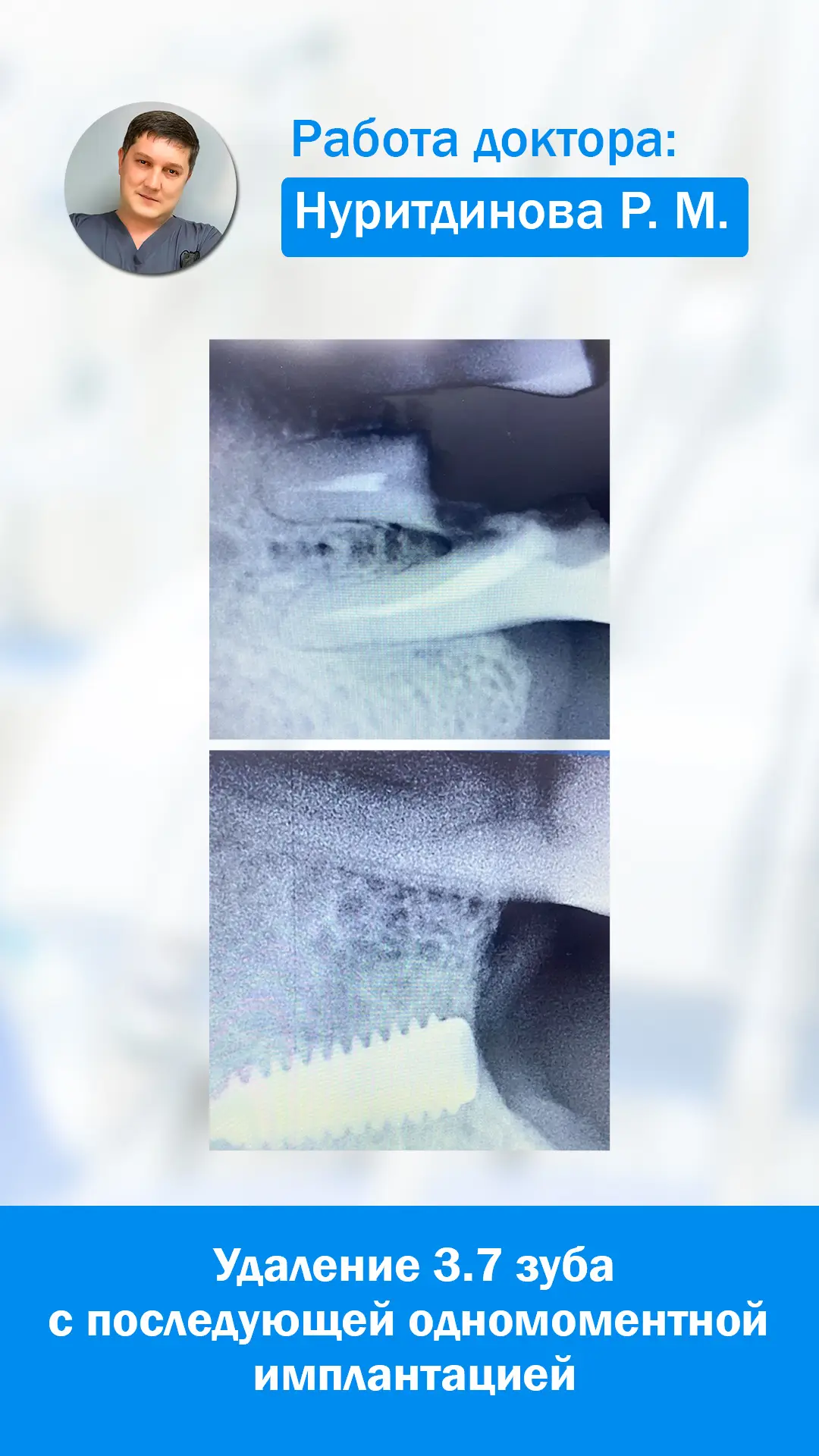 Имплантация