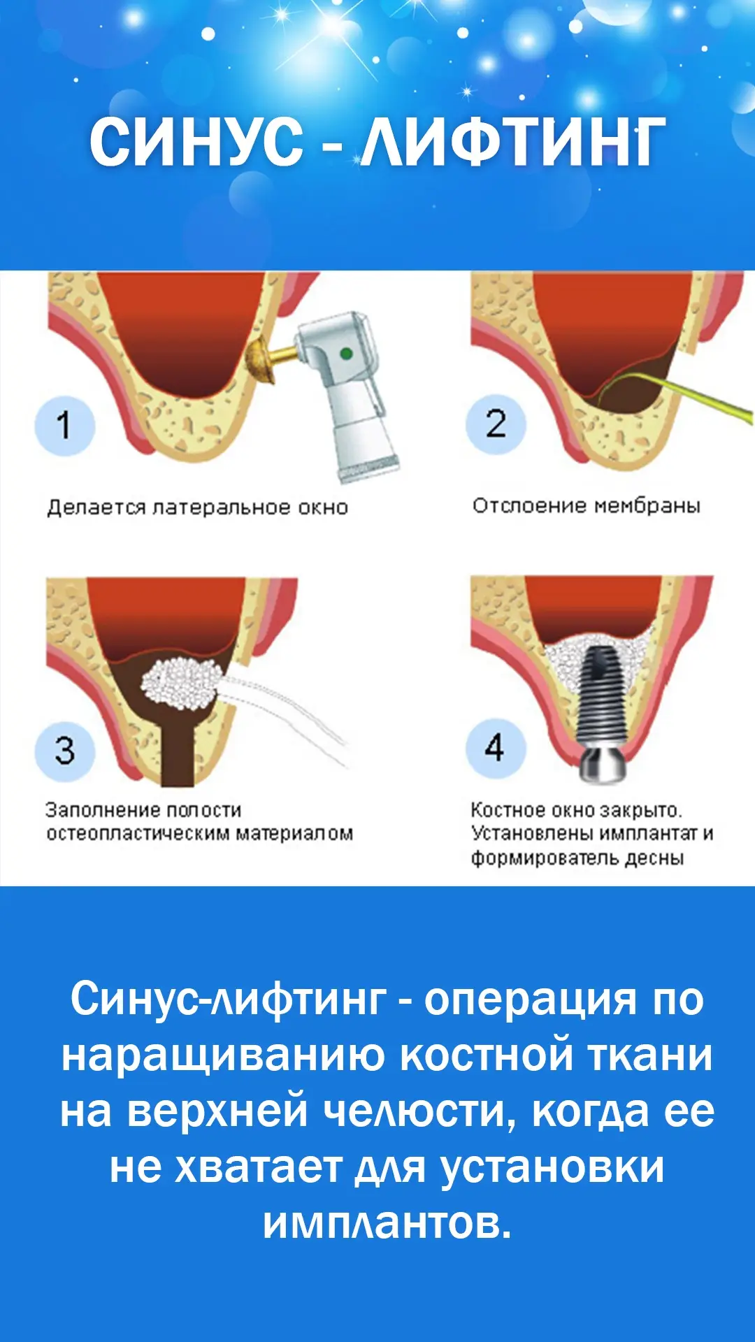 Имплантация