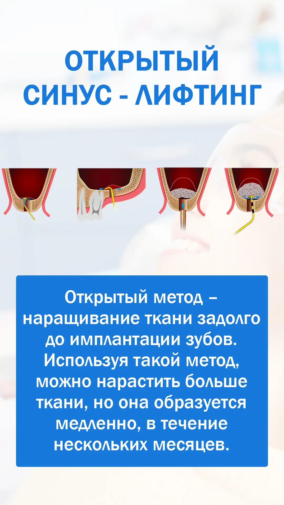 Имплантация