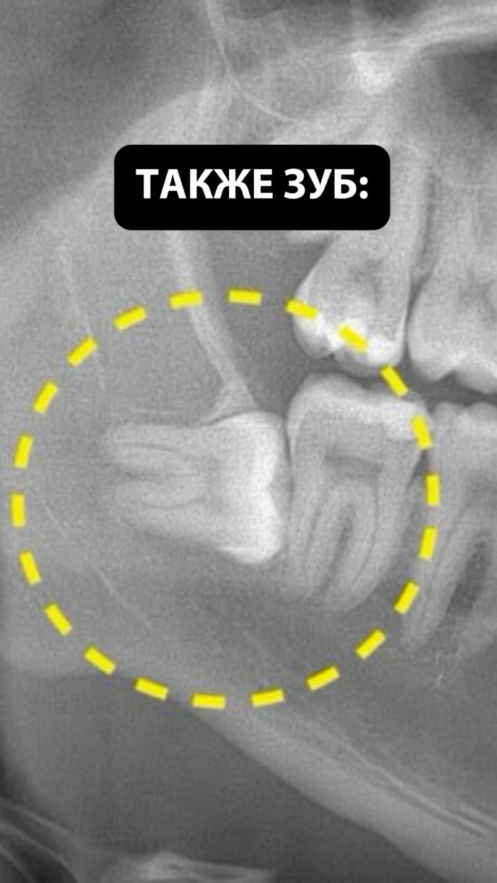 Удаление зубов