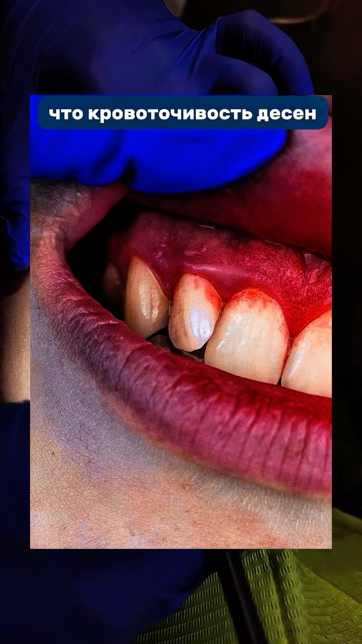 Лечение пародонта